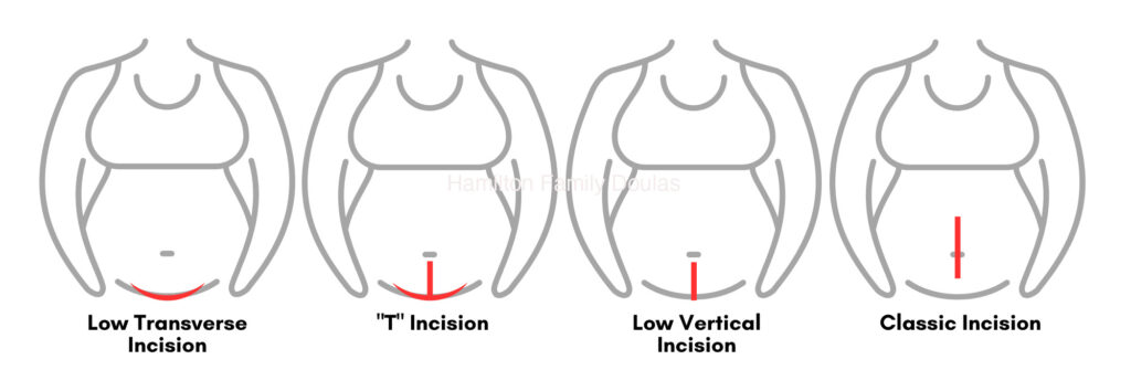 Is VBAC safe? This illustration shows different types of csection incisions.